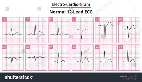 ecg 12 lead normal|Iba pa.